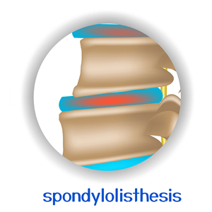 picture of Sitka spondylolisthesis